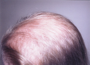 44 year old patient with hereditary Ludwig Type III severe alopecia 