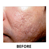 Acne Scarring