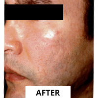 Acne Scarring