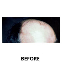 Hair Transplantation