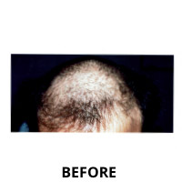 Hair Transplantation