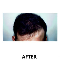 Hair Transplantation