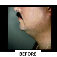 Liposculpture