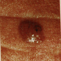 Skin Cancer