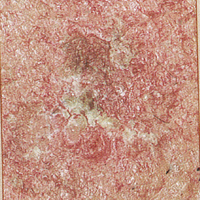 Skin Cancer