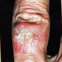 Skin Cancer