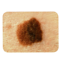 Skin Cancer