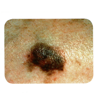 Skin Cancer