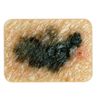 Skin Cancer