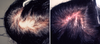 Hair Restoration